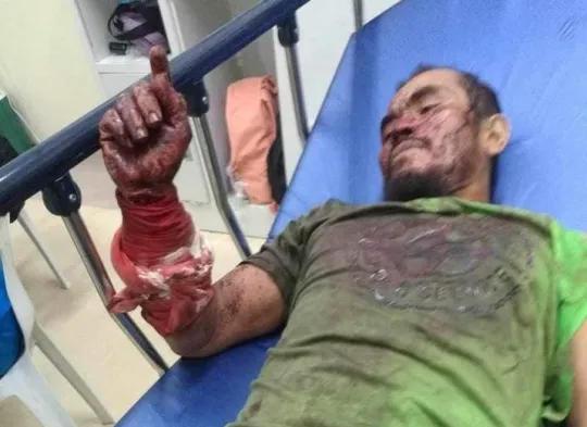 菲律宾男人咬死3米巨蟒：遭蟒蛇咬伤缠死后，他狠咬蛇脖子自救
